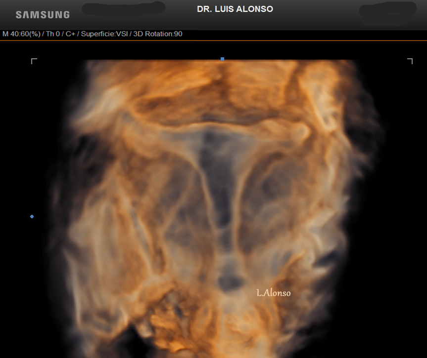 Diagnóstico de los úteros en T (T-shaped uterus)