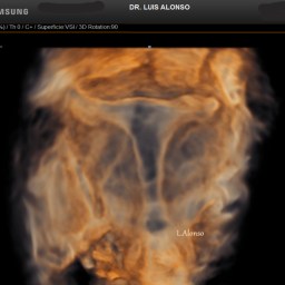 Diagnóstico de los úteros en T (T-shaped uterus)