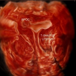 Cirugía histeroscópica para el útero dismórfico: ¿De verdad mejora los resultados?