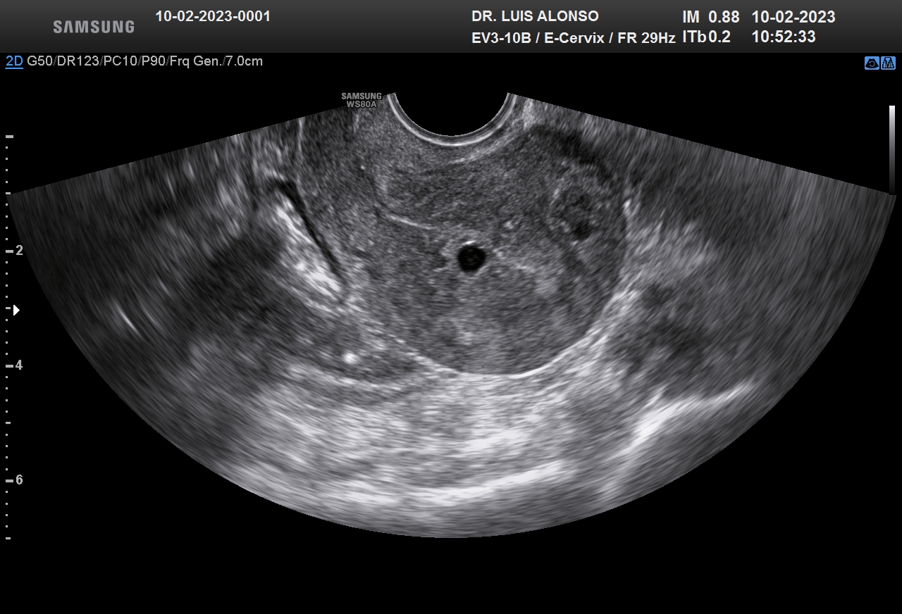 ¿Tengo adenomiosis?