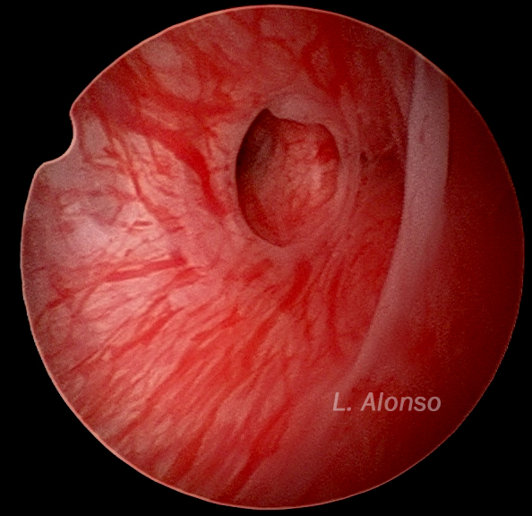 Adenomyosis