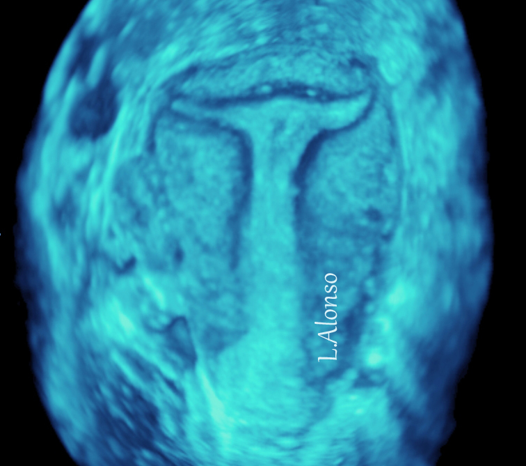 T-Shaped Uterus: A Problem That May Affect Reproductive Outcomes
